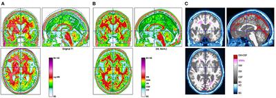 The Impact of Common Epidemiological Factors on Gray and White Matter Volumes in Magnetic Resonance Imaging–Is Prevention of Brain Degeneration Possible?